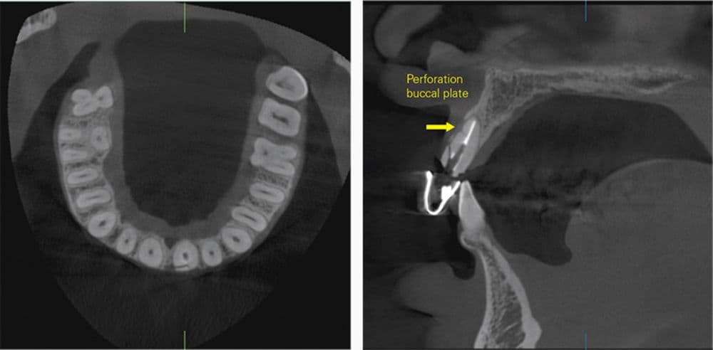 R100 Endo Case