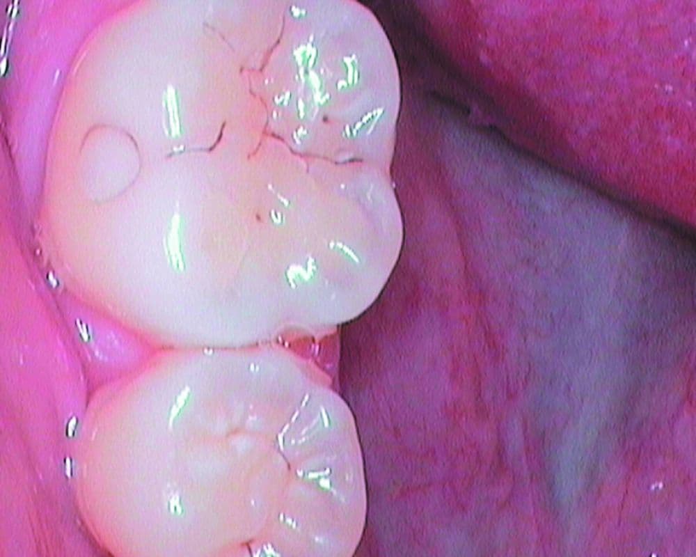 SOPRO717 Infiltrated occlusal groove