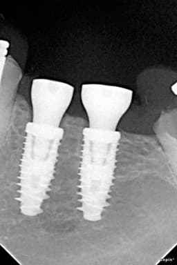 SOPIX2 Implants