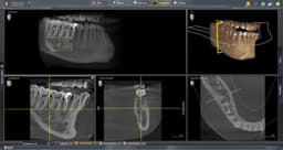 Axeos 5x5 HD pre-molar X-ray