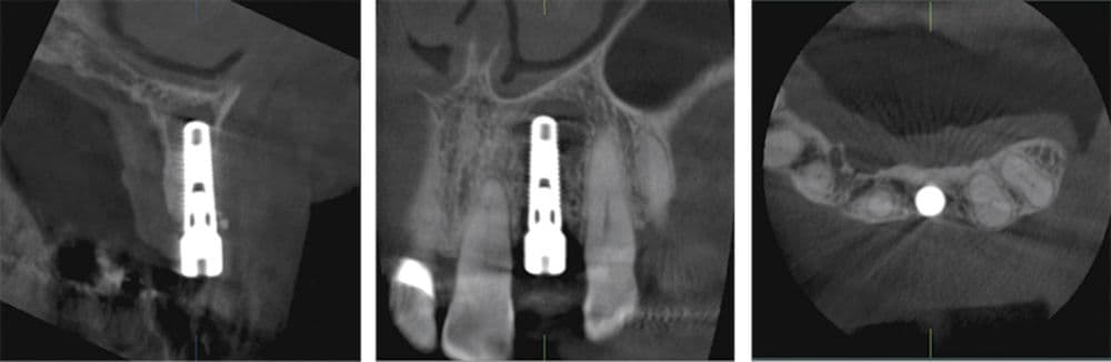 R100 Implant Case