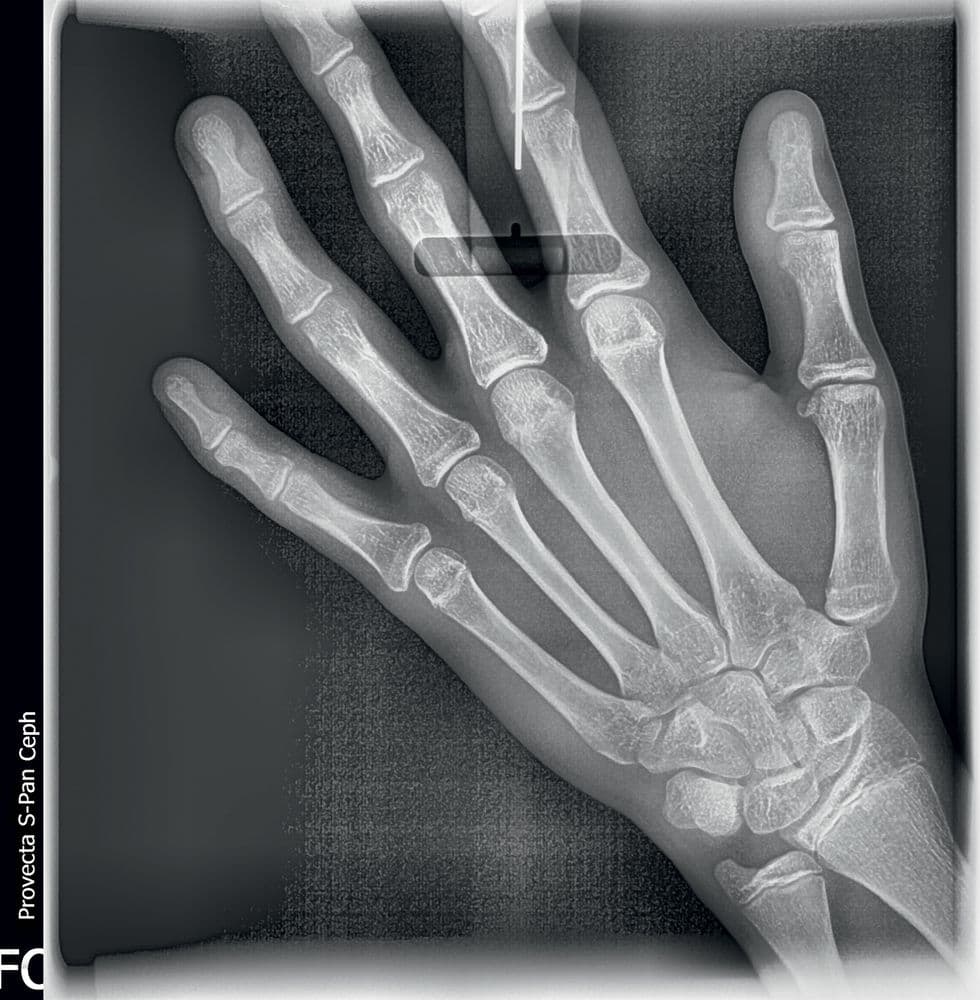 CARPUS X-Ray