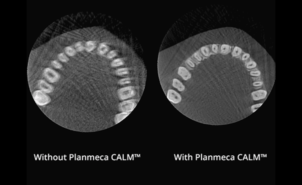 Left image is a standard scan without Planmeca CALM™, the right image is the improved image with Planmeca CALM™