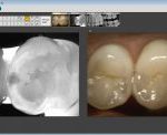 Putting Caries Detection to Use