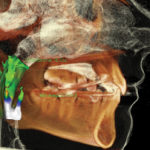 Airway Analysis in 3D with i-CAT