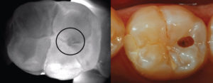 CariVu showing caries detection