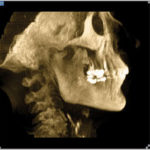 A Case Study of Acute Changes in Dental Occlusion: Digital CBCT Analysis