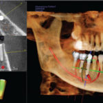 CBCT-A Clear Perspective on Implant Options