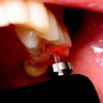 Laser Caries Detection: For Children Of All Ages