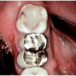 Dental Implants in the Dental Practice, Part Two