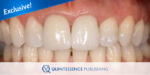 The three-layer technique for immediate implants on teeth without a buccal bone wall: a case report