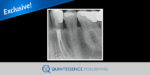 Root canal treatment of a mandibular first premolar with a category 3 C-shaped root canal anatomy: a case report
