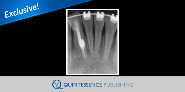 The importance of cone beam computed tomography in the management of internal root resorption: a case report